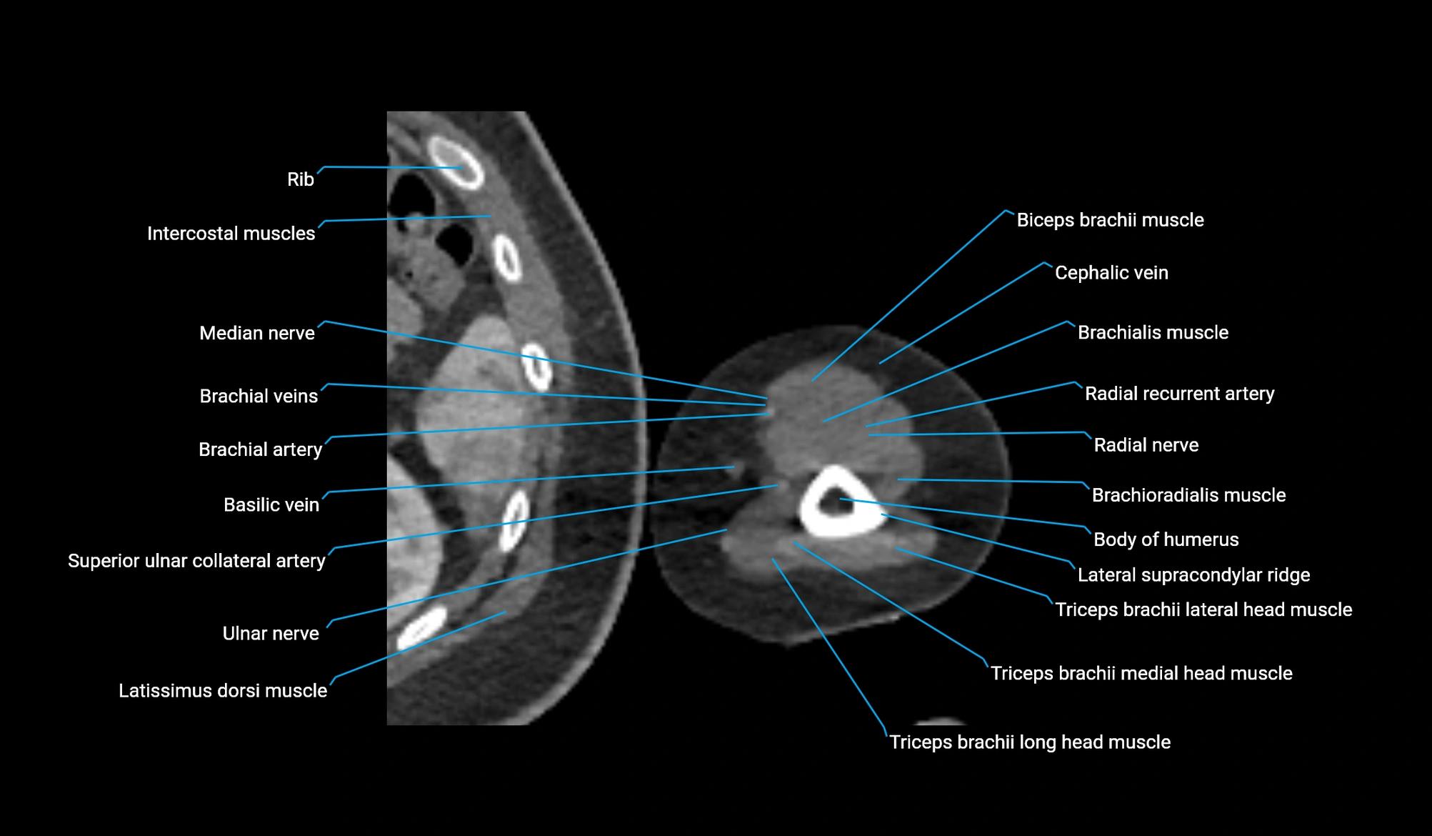 CT upper arm axial  cross sectional anatomy labelled radiology image -00332.webp